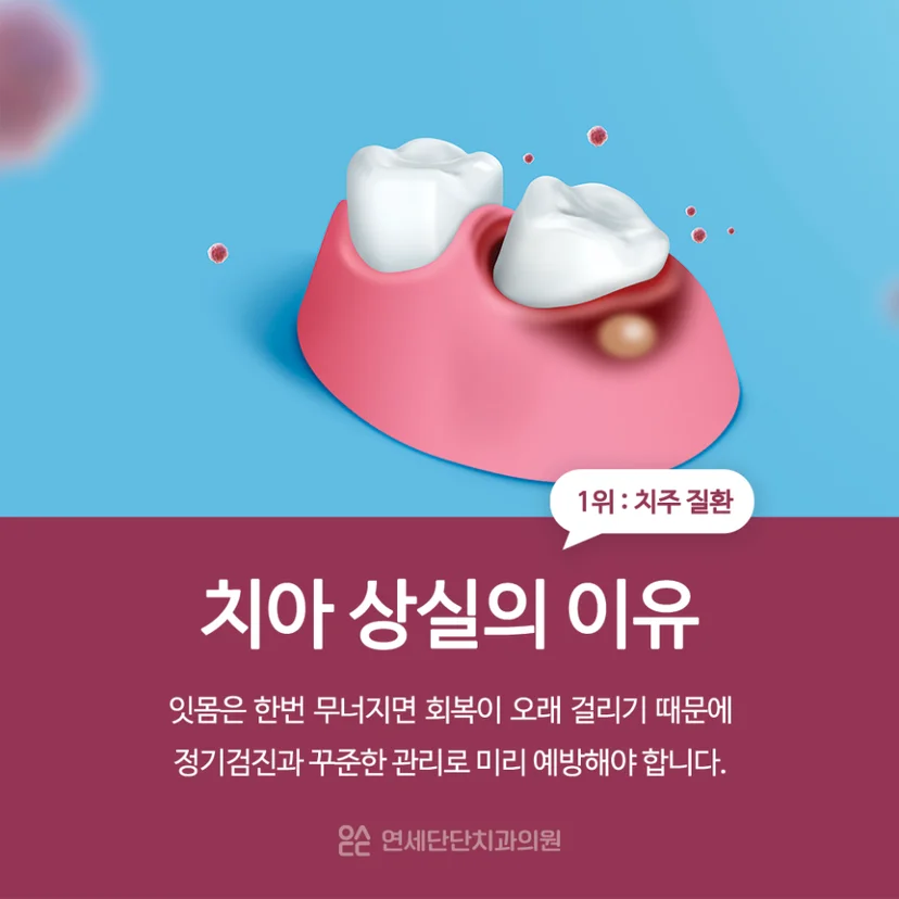 치아 상실을 유발하는 치주 질환