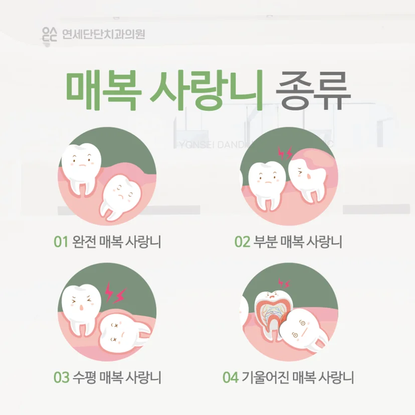 사랑니 종류