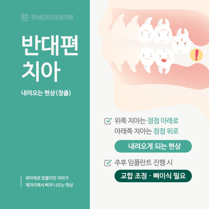 치아 상실 후 정출