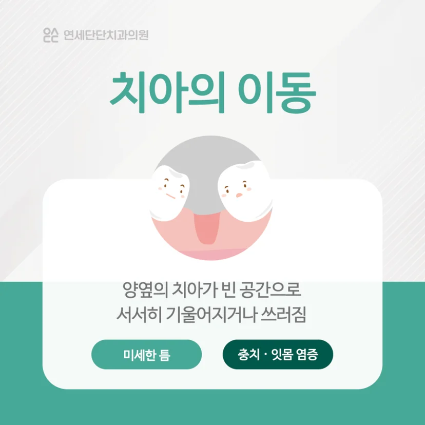 치아 상실 후 치아 이동