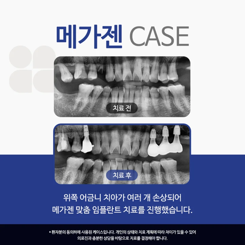 메가젠 임플란트 사례