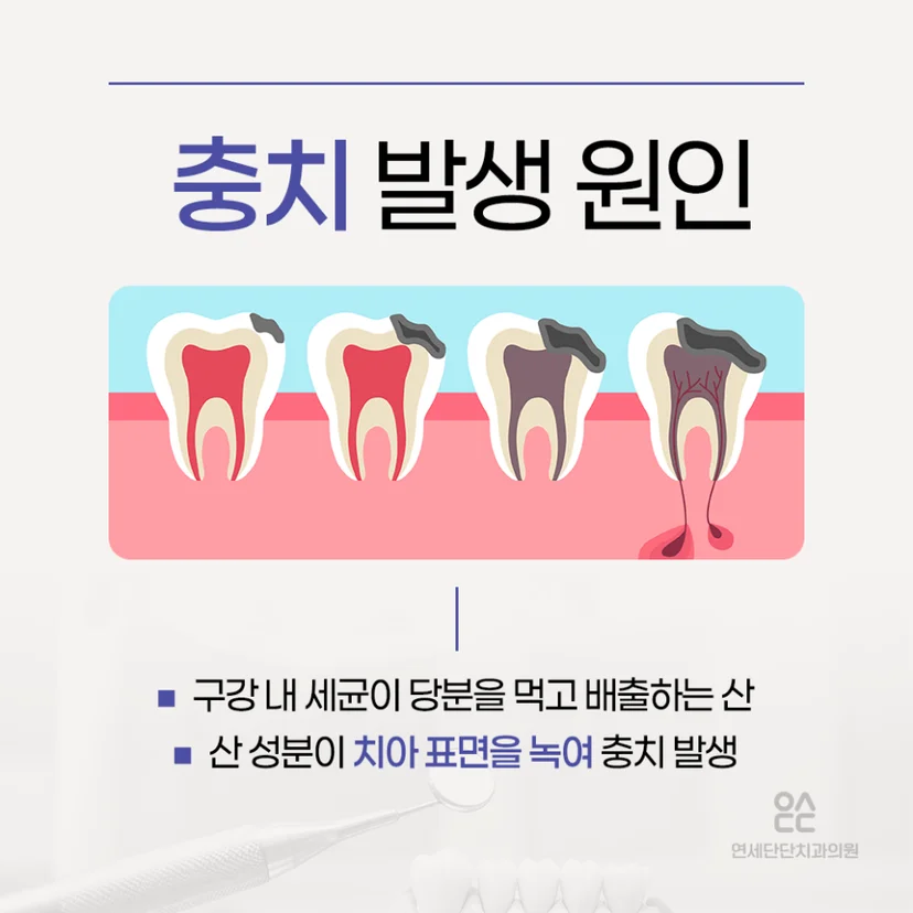 충치 발생 원인