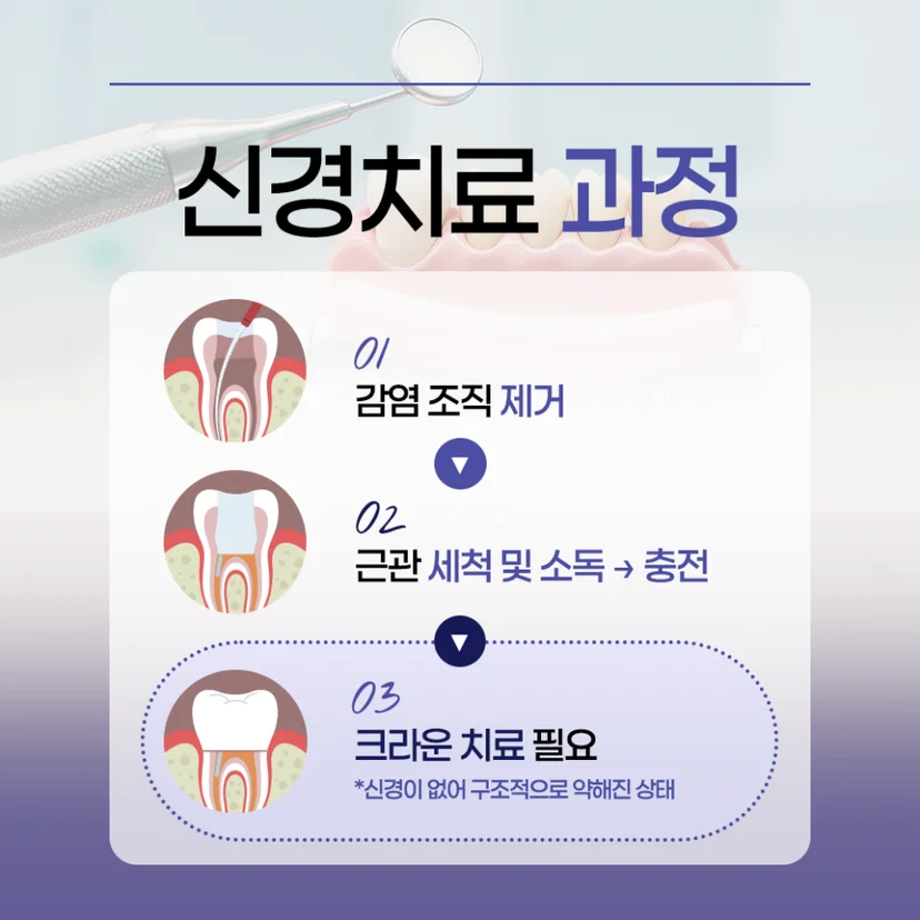 신경치료 과정