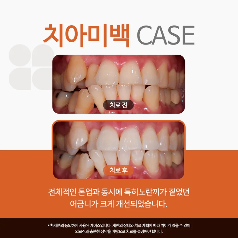 치아미백 케이스