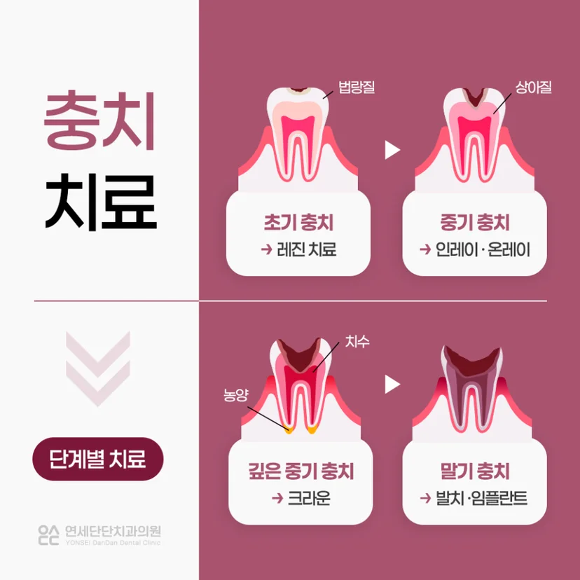 충치 치료