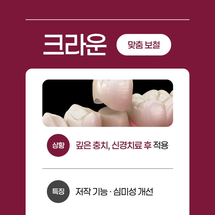 크라운 충치 치료