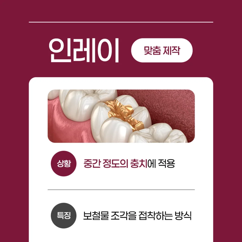 인레이 충치 치료