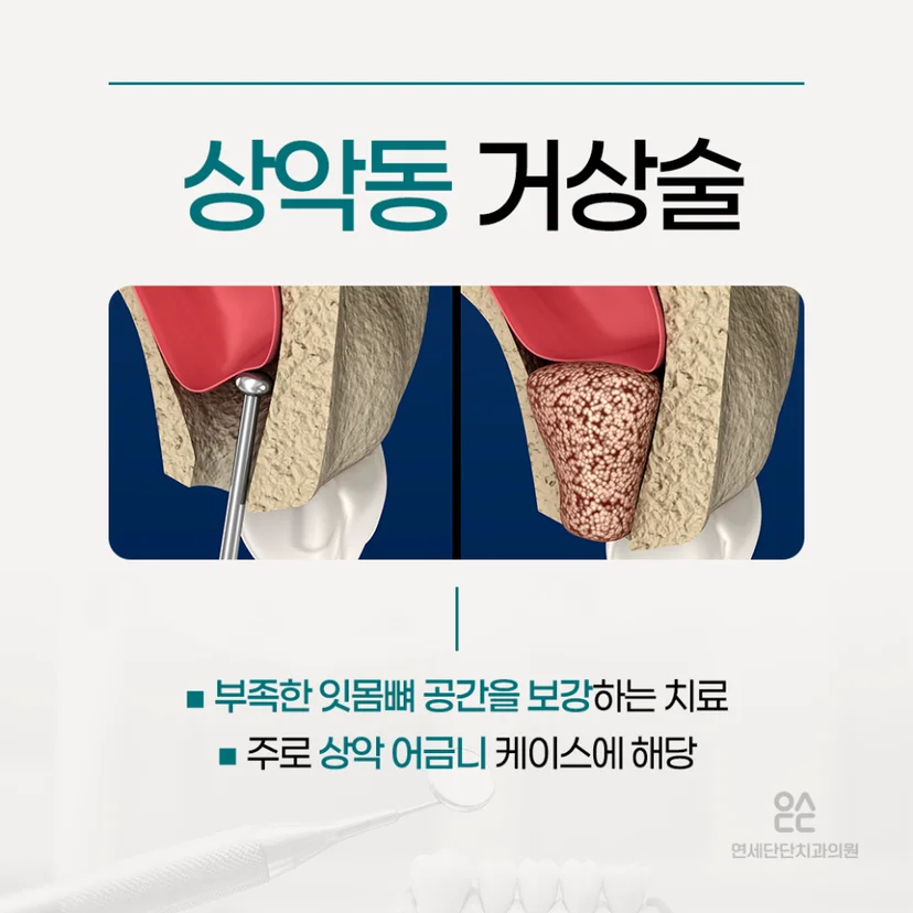 임플란트 상악동 거상술 설명