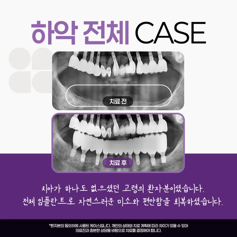 전체 임플란트