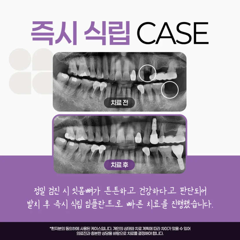 즉시 식립 임플란트