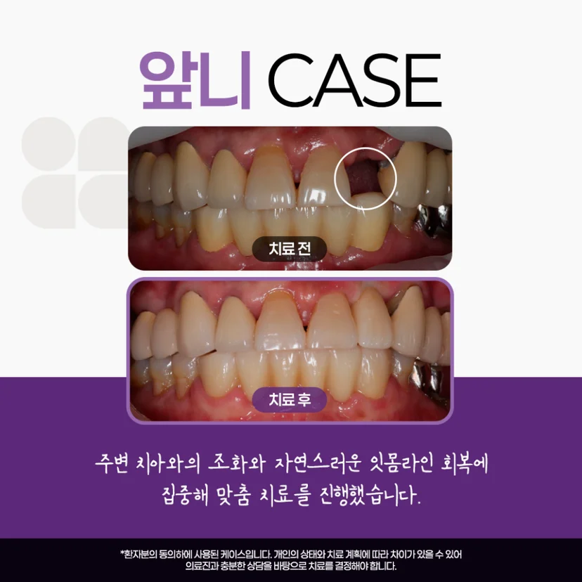 앞니 임플란트