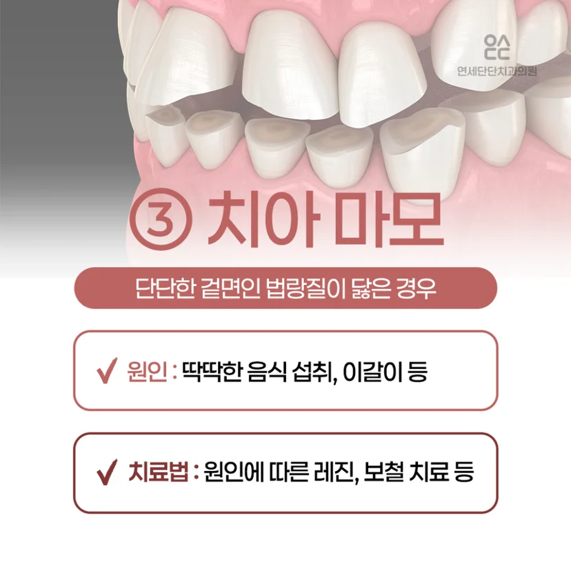 이 시림 원인, 치아 마모