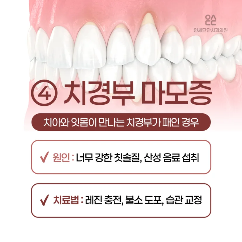 이 시림 원인, 치경부 마모증