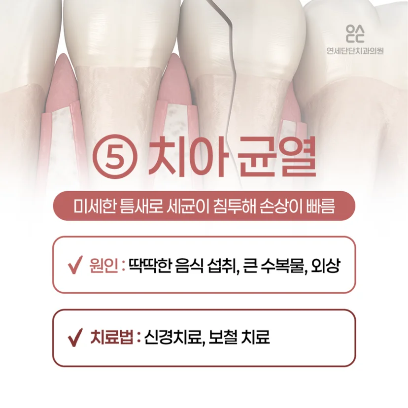 이 시림 원인, 치아 균열