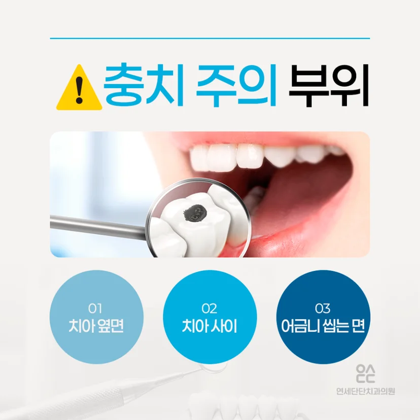 충치 주의 부위
