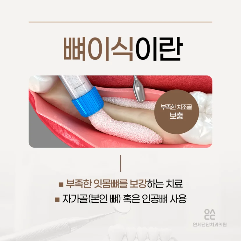 임플란트 뼈이식 설명