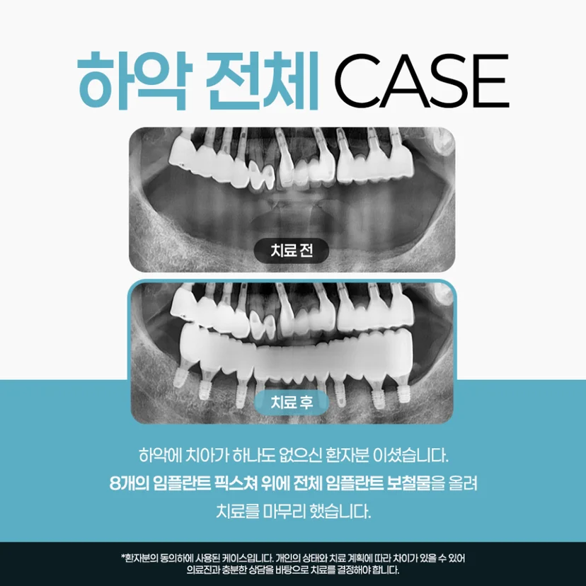 하악 전체 임플란트