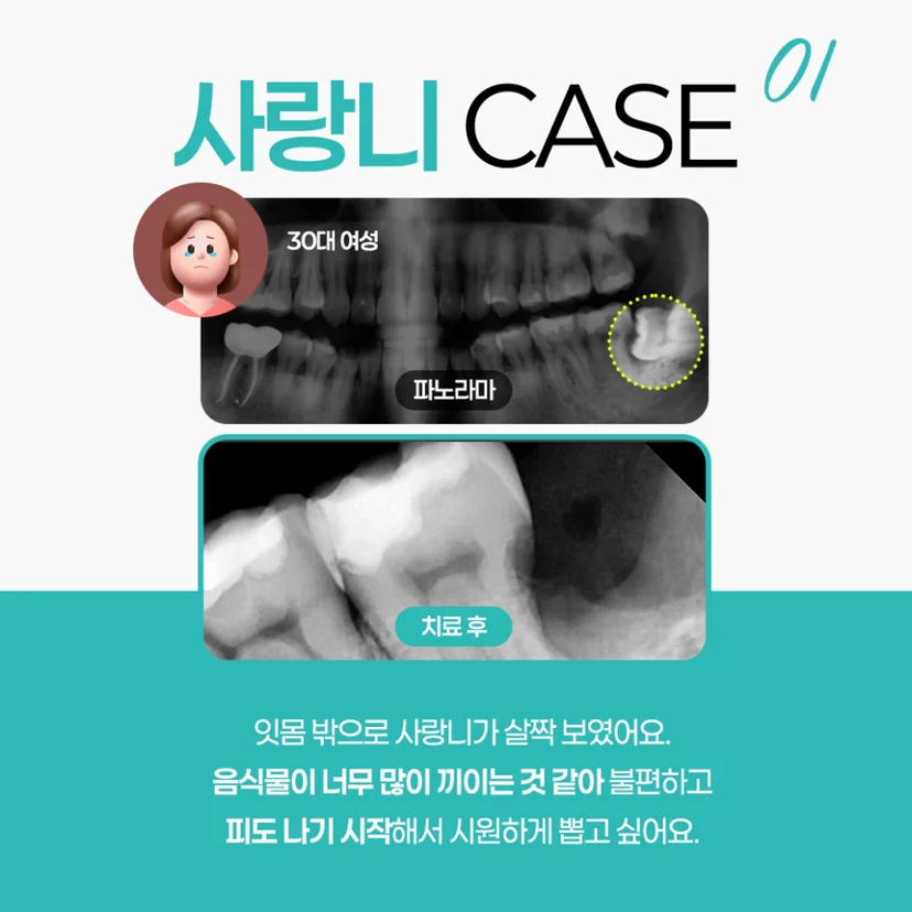 매복 사랑니 빌치 사례