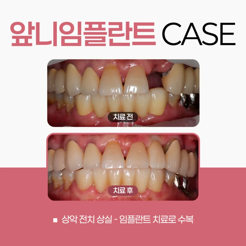 앞니 임플란트 사례