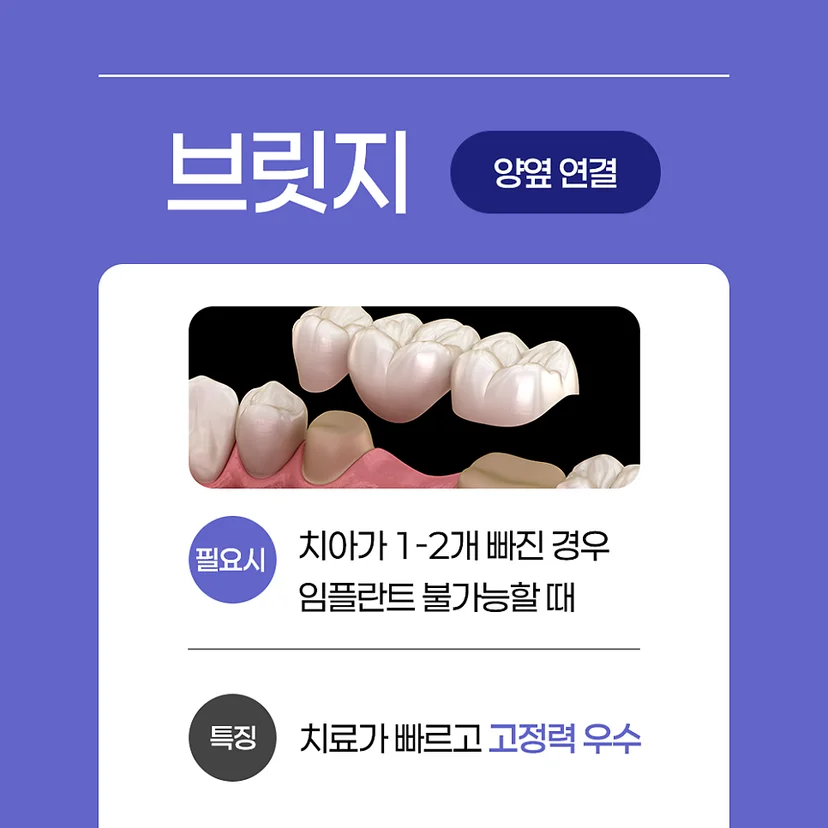 브릿지 보철치료
