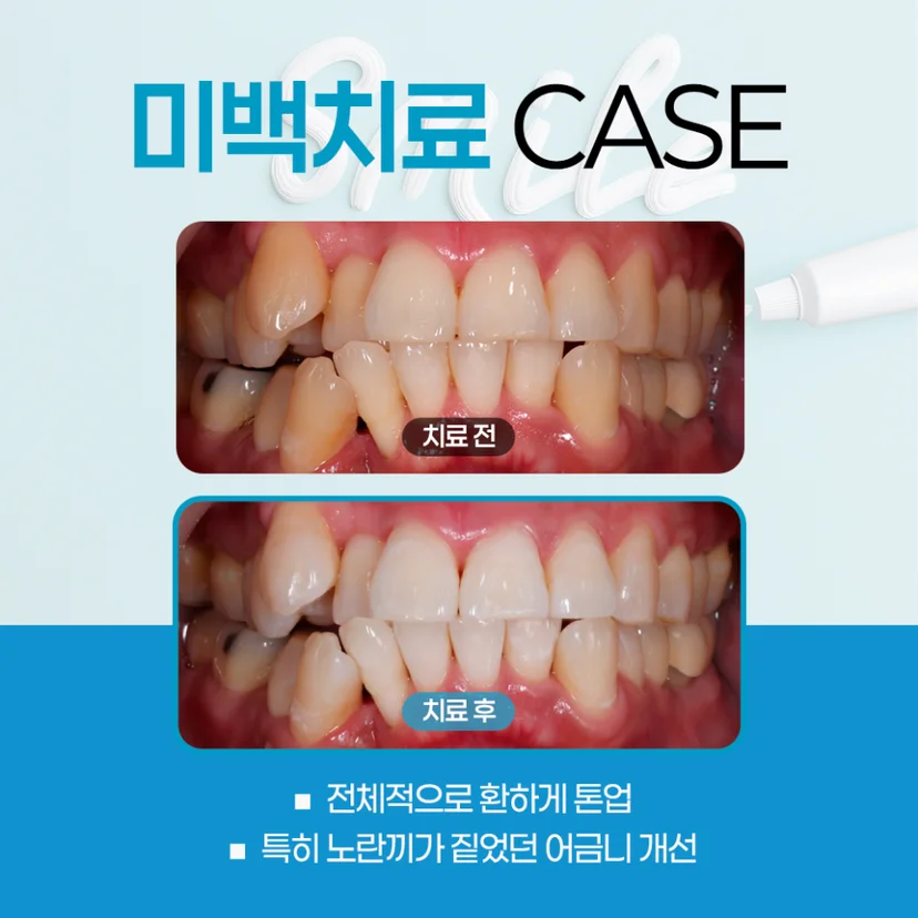 치아미백 사례