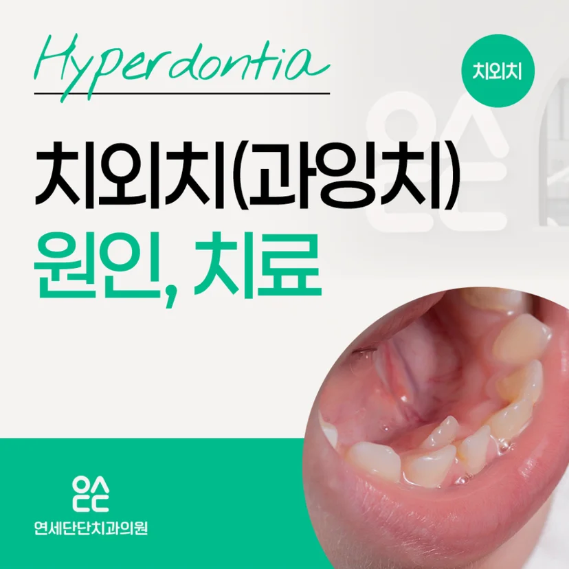 치외치 표지