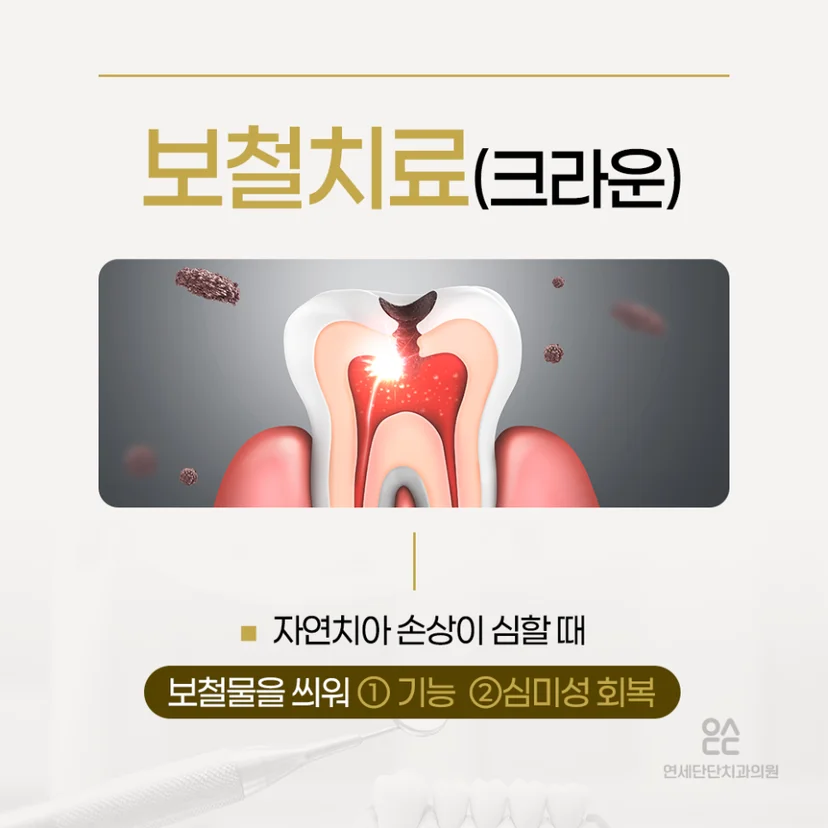 크라운 보철치료 설명