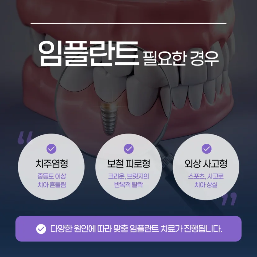 임플란트가 필요한 경우