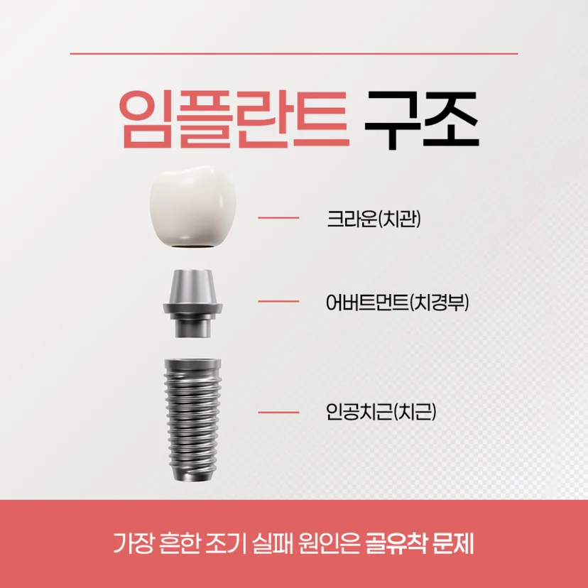 임플란트 구조