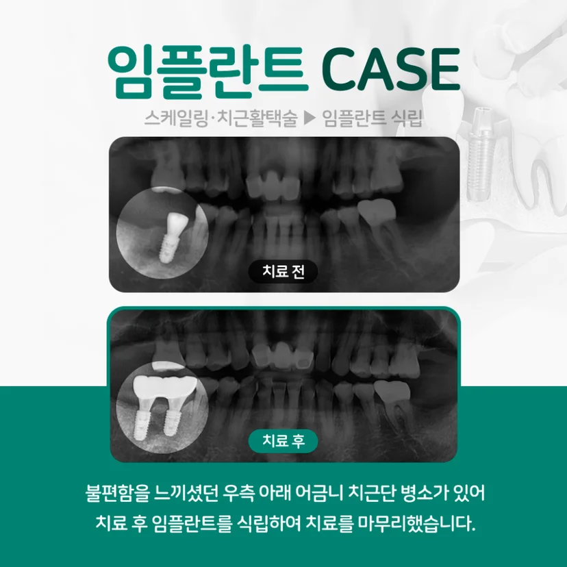 임플란트 케이스