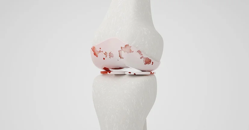 연골이 닳아 없어져 뼈가 맞닿는 퇴행성 무릎관절염의 진행 과정을 보여주는 3D 정밀 관절 이미지