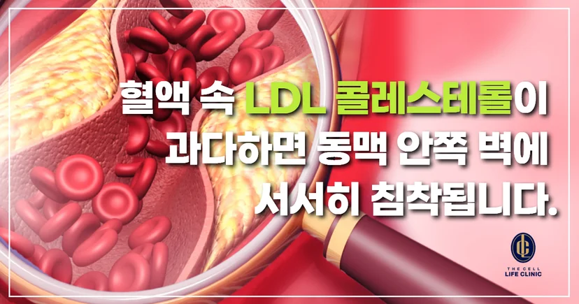 LDL콜레스테롤 많으면 동맥 벽에 플라크가 서서히 침착하는 모습