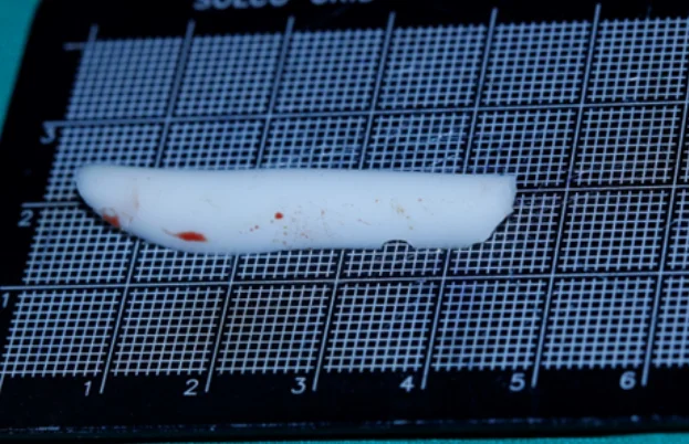 [코비쥬의원] 코보형물 제거 과정에서 제거한 실리콘 보형물을 촬영한 실물 사진