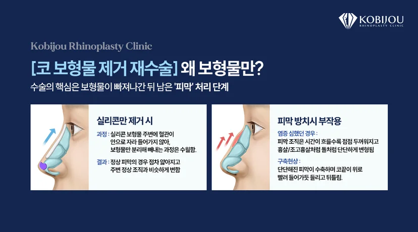 코비쥬의원 코보형물 제거 재수술 정보: 코보형물 제거 재수술 시 실리콘만 제거한 경우와 피막까지 제거한 경우의 차이와 피막 방치 시 발생할 수 있는 구축 위험을 설명한 이미지