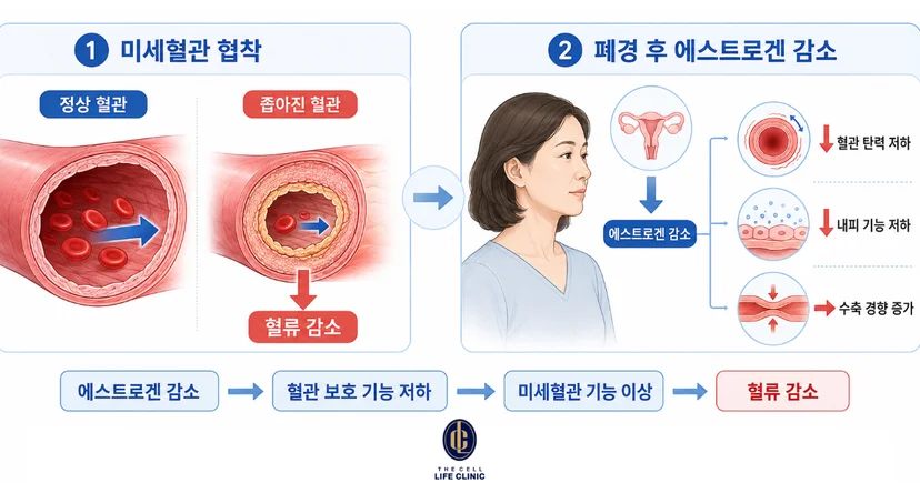 폐경 후 에스트로겐 감소, 미세혈관 협착을 설명하는 그림