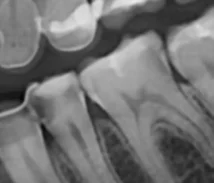 성신여대-신경치료-근관치료-root-canal-진단-방사선사진-성모치과의원