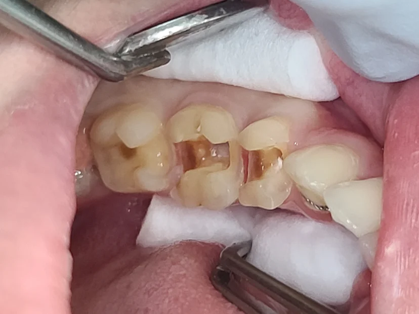 성신여대-신경치료-근관치료-root-canal-근관충전-방사선사진-성모치과의원