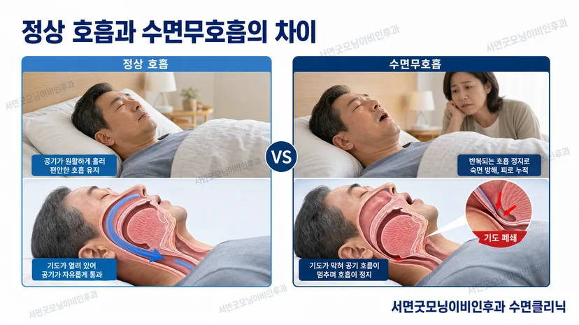 정상 호흡과 수면무호흡 상태