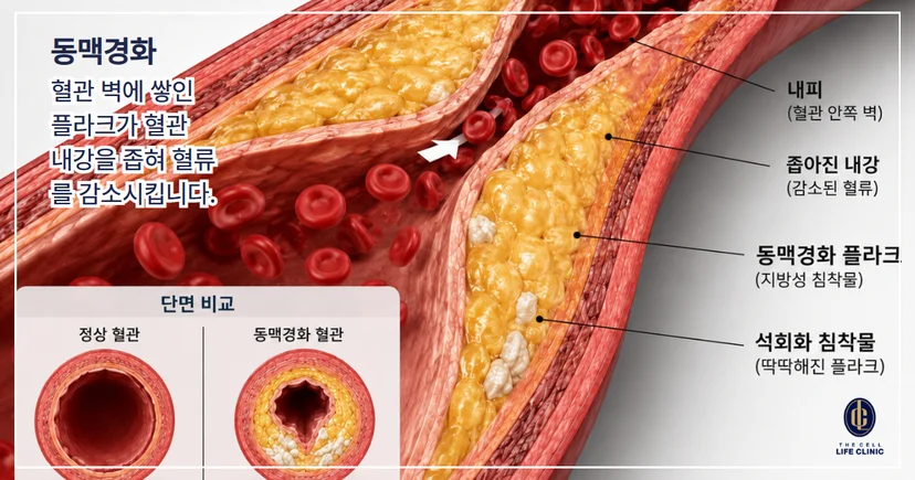 혈관 단면을 비교해서 보여주고 있으며 내피, 내강, 플라크의 위치를 표시하고 있다