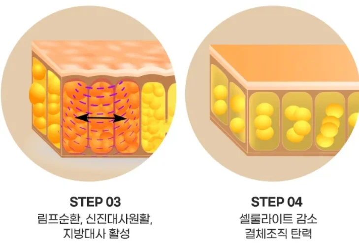 셀룰라이트 개선, 결체조직 탄력