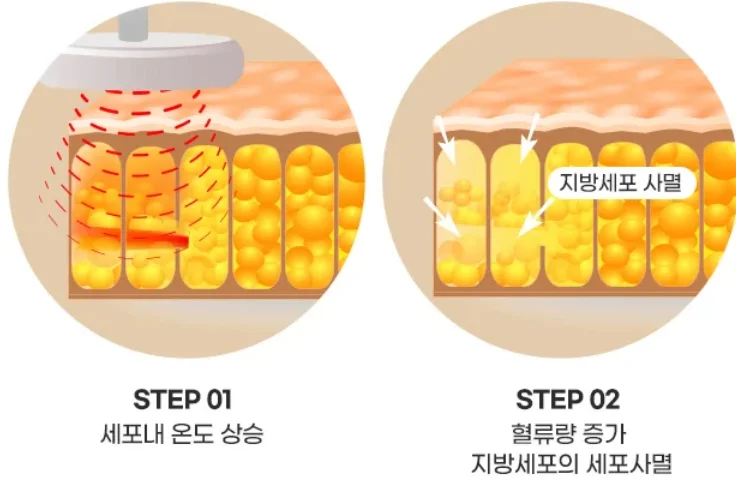 고주파기기 지방세포 감소, 혈류량 증가