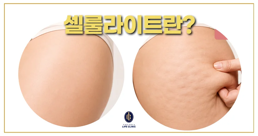 허벅지 셀룰라이트 표현한 그림