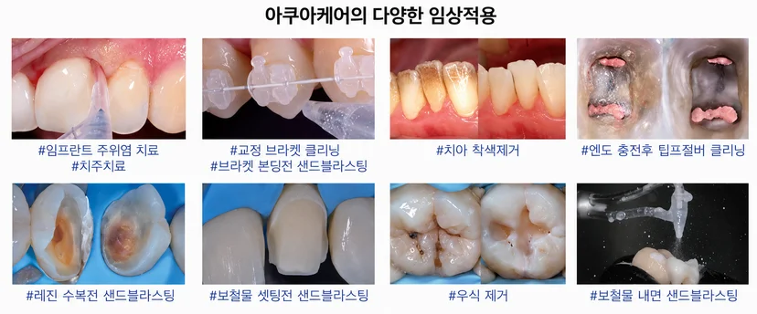 성북구-아쿠아케어-air-abrasion-임플란트-브라켓-보철-착색제거-임상적용-성모치과의원