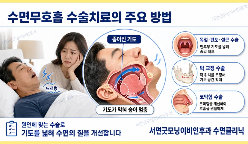 수면무호흡증 수술 치료