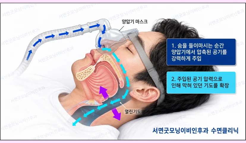 양압기 치료