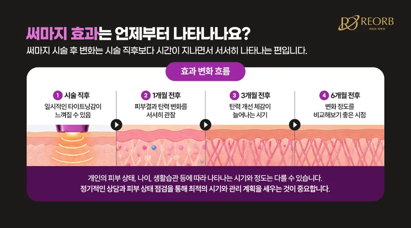 리오브피부과 써마지리프팅 효과 시기