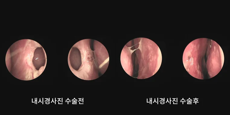 [코비쥬의원] 비중격 천공 복원 수술 전후 코 내부 상태를 확인한 내시경 사진