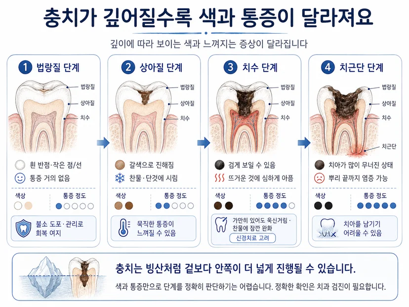 충치 진행 단계 법랑질 상아질 치수 치근단 증상 단면도
