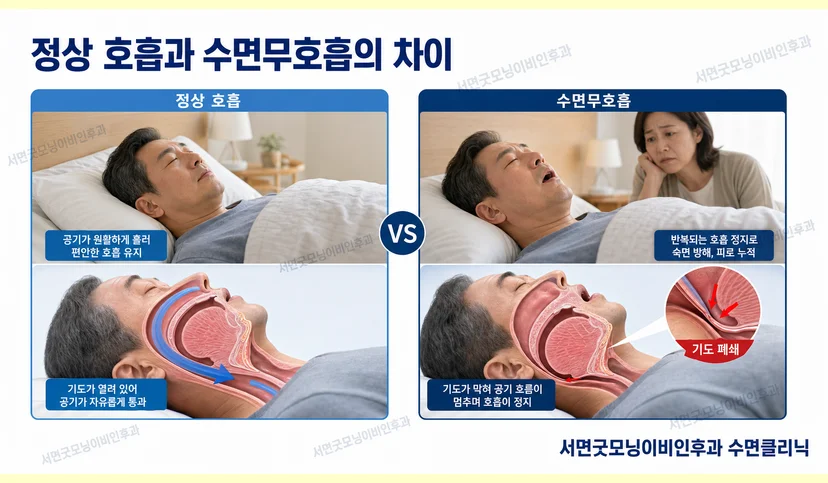 정상 호흡과 수면무호흡의 차이점은?