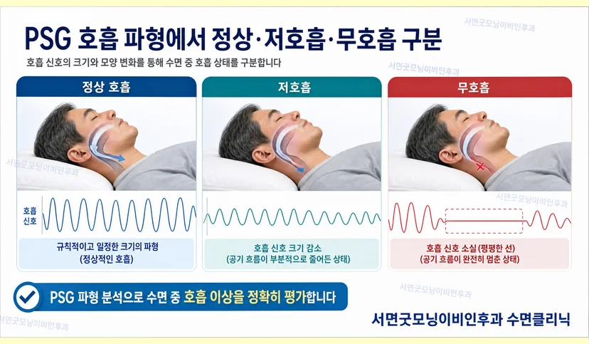 수면다원검사 호흡 파형 종류